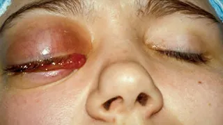 Periorbital Cellulitis