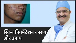 All About Skin Pigmentation (स्किन पिगमेंटेशन कारण और उपाय) | ClearSkin, Pune | (In HINDI)