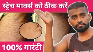 Stretch Marks - स्ट्रेच मार्क्स को ठीक करें (100% गारंटी) | desi gym fitness