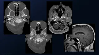 Microsurgical Resection of a Recurrent Foramen Magnum Meningioma