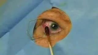 Intravitreal Injection Technique