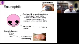 Lecture: Vernal Keratoconjunctivitis