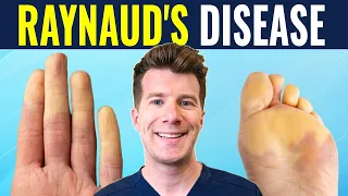 Doctor explains Raynaud's disease and syndrome | Causes, prevention and treatment