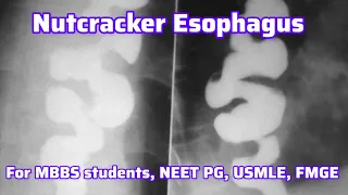 Nutcracker Esophagus For MBBS students, Neet PG, Usmle, FMGE I Neet PG Usmle Preparation