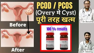 Best homeopathic medicine for PCOD/PCOS- overy me cyst ka homeopathic ilaj