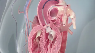 Transcatheter Aortic Valve Implantation (TAVI) Procedure Animation