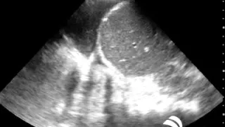 SonoSim Ultrasound Video Challenge - Pulmonary