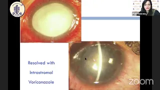 Practical Tips in Management of Fungal Keratitis -Prof. Namrata Sharma