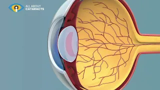 Formation of a cataracts video animation