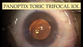 Alcon PanOptix Trifocal Toric IOL I Dr Pritam Dedhia I Cataract Surgeon I Vasai - Virar