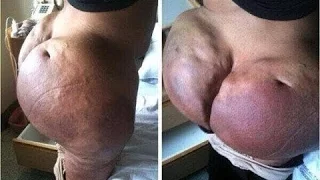 Woman put in Prison For Giving Botched Butt Injections