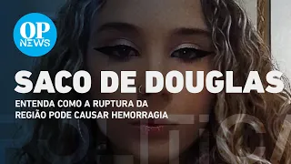 Saiba o que é saco de Douglas e como sua ruptura pode causar hemorragia ou até a morte | O POVO NEWS