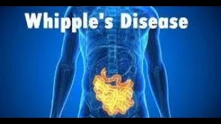 Whipple Disease | Whipple Disease Symptoms | Whipple Disease Causes