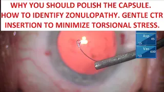 Why You Should Polish the Capsule. Tricks to Identify Zonulopathy. Sinsky Hook CTR Insertion.