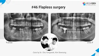 Dr. Yongseok CHO, Sewoung KIM, #46 Flapless surgery and prosthesis