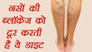 बंद नसों को खोलती है ये डाइट | Diet for blocked Veins | Varicose veins | Boldsky