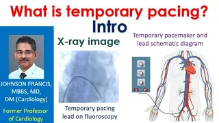 What is temporary pacing? Intro