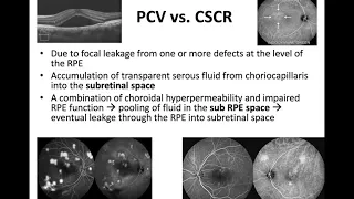 Polypoidal Choroidal Vasculopathy - Dr Fadwa AlAdel