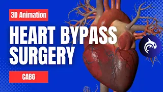 Heart Bypass Surgery (Coronary Artery Bypass Graft CABG) - 3D Animation