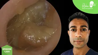 1,323 - Huge Chunks of Ear Wax Removed