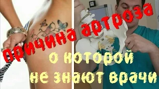 Причины артроза о которых не знают врачи.  Causes of osteoarthritis which doctors do not know