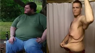 Man Bravely Shows Excess Skin after Naturally Losing 400 Pounds