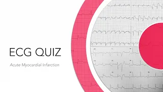 ECG Quiz: Acute Myocardial Infarction