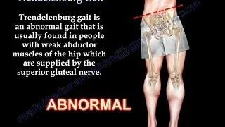 Trendelenburg Gait - Everything You Need To Know - Dr. Nabil Ebraheim