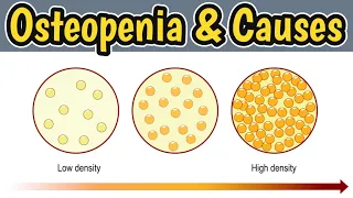 Causes Of Osteopenia | Low Bone Mass | What Is Osteopenia |