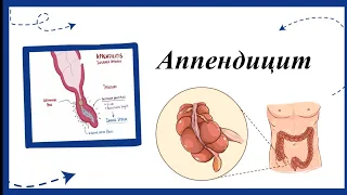 Аппендицит/Қысқа да нұсқа