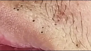 BEAUTY OF SQUEEZE😨 BLACKHEADS REMOVAL FROM THE LIPS #3  #relaxing  #blackheads