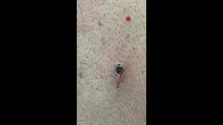 Big Blackhead Removal (DPOW) | CONTOUR DERMATOLOGY #shorts