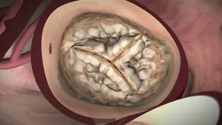 Transcatheter Aortic Valve Replacement (TAVR) - A Less-Invasive Alternative to Open Heart Surgery