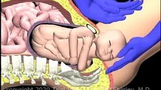 Shoulder Dystocia Suprapubic Pressure Animation by Cal Shipley, M.D.