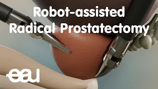 Robot-assisted Radical Prostatectomy (RARP)