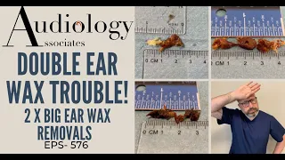 DOUBLE EAR WAX TROUBLE - EP576