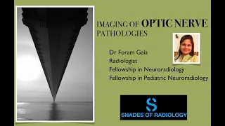 OPTIC NERVE pathologies- SIMPLIFIED