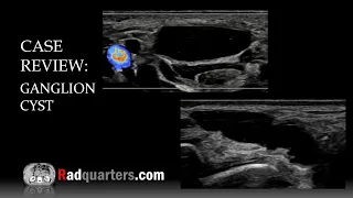 Ultrasound of Ganglion Cyst & Wrist Anatomy Review