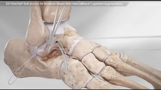 DX FiberTak® Soft Anchor for Brostrom Repair With InternalBrace™ Ligament Augmentation