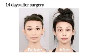 Jaw Surgery & Rhinoplasty Before and After | Seoul Guide Medical