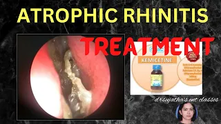 194.Atrophic Rhinitis Part 2/2  #Atrophic rhinitis treatment #clinicalexamination #rhinitis