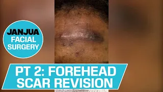 FOREHEAD SCAR REVISION PART 2 - DR. TANVEER JANJUA - NEW JERSEY