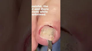 Onycholysis-(Ipad Dropped on Toe) #toenail_removal #toenail