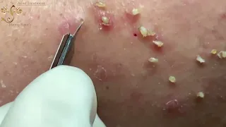 Blackheads Extraction Whiteheads Removal Pimple Popping #3