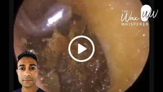 970 - Enormous Ear Wax & Dead Skin Plugs Extracted