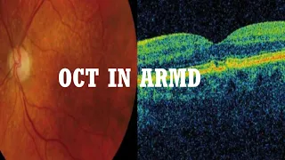 OCT in AMD( Age related macular degeneration