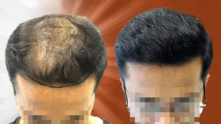 Grade 5 Diffuse Baldness Transformed with 5000 Grafts | Hair Restoration in Bangalore