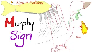 Murphy Sign for Cholecystitis | Signs in Medicine Series