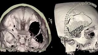 Spheno-Orbital Meningioma Removal - A True Skull Base Surgery