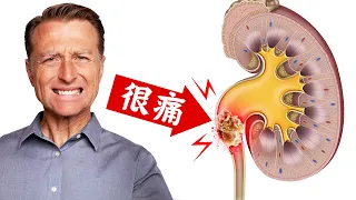 最痛的腎結石,預防6種自然療法,柏格醫生 Dr Berg